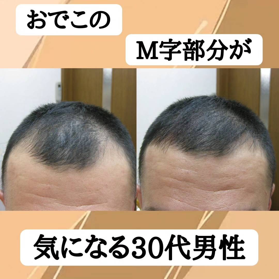 おでこのM字が気になる30代男性